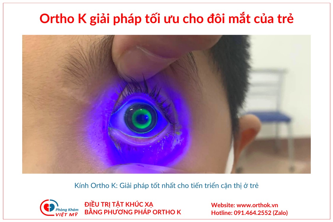Điều trị tật cận thị bằng kính áp tròng đeo ban đêm Ortho k