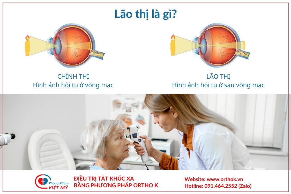 Điều trị tật cận thị bằng kính áp tròng đeo ban đêm Ortho k